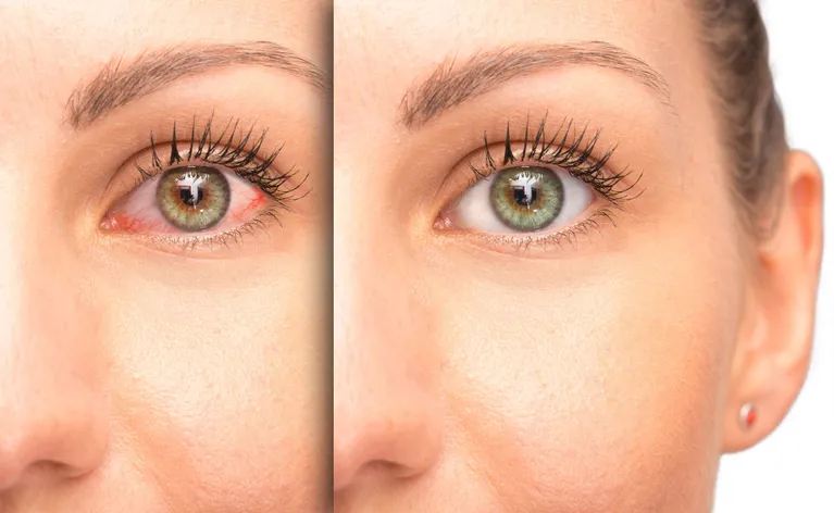 Glaucoma Treatment